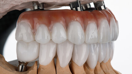 side view of dental prosthesis made of zircon of the upper jaw and crown of the lower jaw on a...