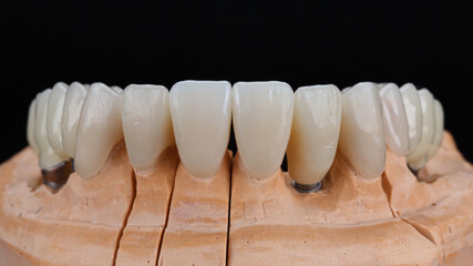 dental model of the upper jaw with zircon crowns on a black background © Dental Pro Content