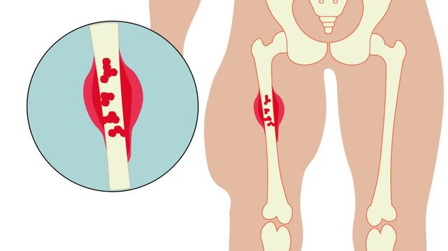 Bone cancer,sarcoma,Adamantinoma,Chondrosarcoma,Ewing's sarcoma,Fibrocartilaginous mesenchymoma,Malignant fibrous histiocytoma,Osteosarcoma,Rhabdomyosarcoma, tumor,bone tissue,multiple myeloma