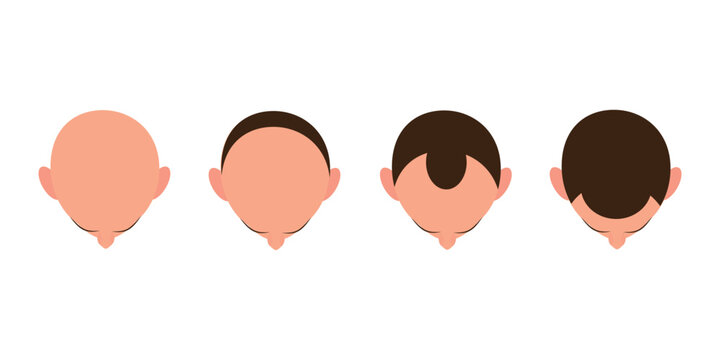 Hair loss bald head alopecia transplant growth vector top view. Hair loss men top view alopecia scalp problem