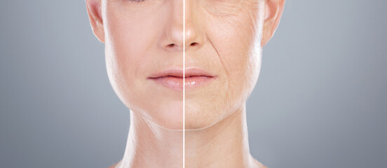 Collage, before after and face of woman for skincare, anti aging and beauty with surgery in studio....
