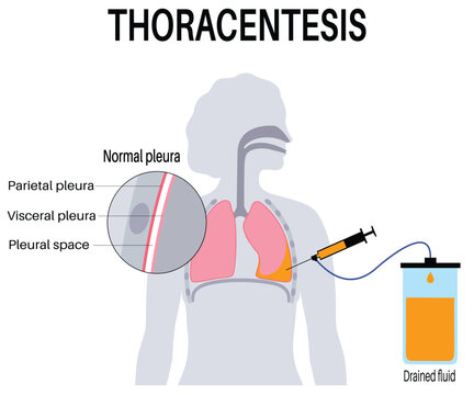 Thoracentesis Procedure Medical Poster: Chest Wall Incision for Fluid Removal, Unhealthy Lungs, Respiratory System Disease Vector Illustration
