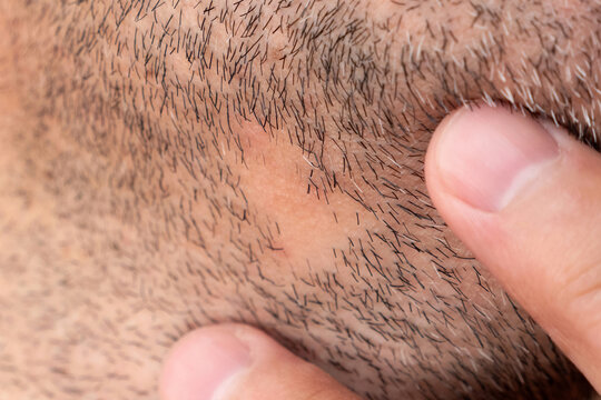Alopecia on the beard of a man. Baldness on the hairline.