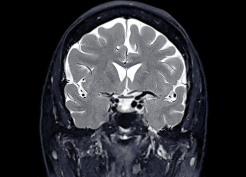 MRI  brain scan  Coronal T2W  for detect  Brain  diseases sush as stroke disease, Brain tumors and Infections.