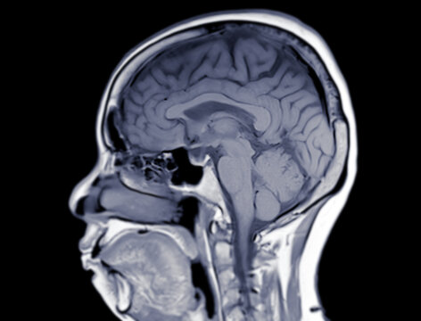 MRI  brain scan  sagittal T1W for detect  Brain  diseases sush as stroke disease, Brain tumors and Infections.