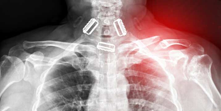 X-ray of both shoulder joints, front view, showing a fracture of the left clavicle.