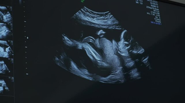 Ultrasound sonogram of fetus actively moving in womb closeup. Regular prenatal checkup services to control healthy development of baby
