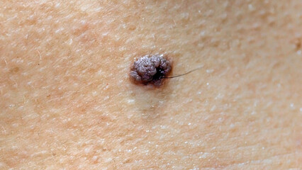 Moles and warts that appear on the body