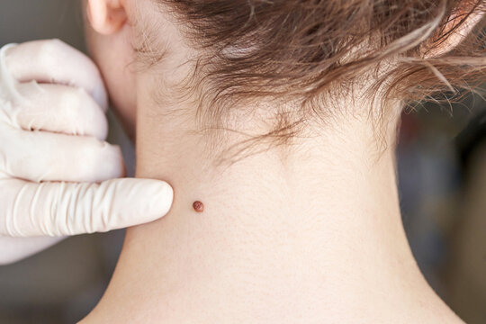Woman examing her abnormal mole. Dermatology procedure. Doctor checking patient skin cancer melanoma. Dark wart at female neck. Back view. Removal papilloma treatment