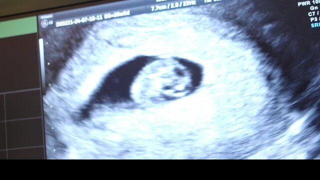 Vaginal ultrasound of a 7-8 week pregnant woman showing fetal heartbeat. Early pregnancy gynecological examination