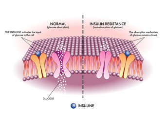 Medical illustration shows in a simple and schematic way the mechanism of insulin resistance, one of the causes of type 2 diabetes.