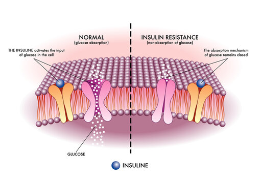Medical illustration shows in a simple and schematic way the mechanism of insulin resistance, one of the causes of type 2 diabetes.