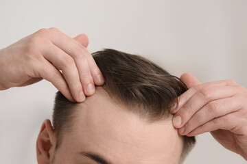 Fototapeta premium Baldness concept. Man with receding hairline indoors, closeup