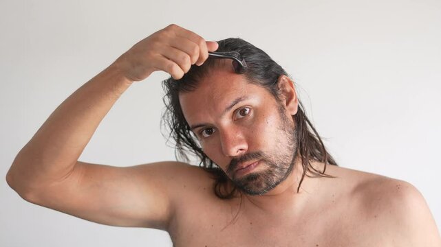 alopecia, microneedling hair loss treatment for bald scalp to regrow hair using dermaroller, collagen induction therapy