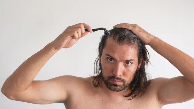 man with hair loss problems, Derma Roller For Hair Loss, stop balding, Alopecia