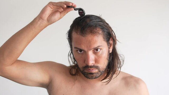 man with hair loss problems, Derma Roller For Hair Loss, stop balding, Thinning hair