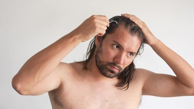 Male pattern baldness, man with hair loss problems, Derma Roller For Hair Loss, stop balding, Alopecia