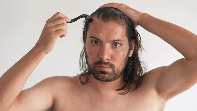 man with hair loss problems, Derma Roller For Hair Loss, stop balding, Balding