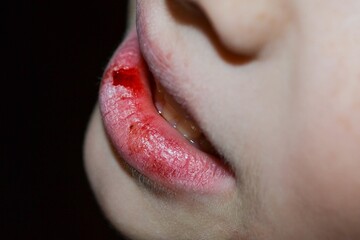 Dry and damaged lips of a girl. Close-up. Lip fissure and bleeding. Sick cracked damaged tissue....