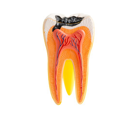 Tooth decay model isolated on white background with clipping path.