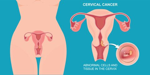 Cervical cancer develops in a womans cervix.