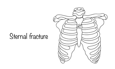 Sternal fracture