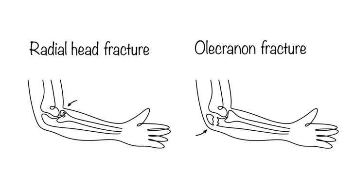 Arm fractures