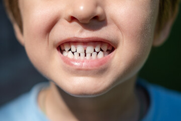 Close-up headshot of little preschool cute boy widely smiling, showing the first baby milk teeth. Happy four or five years old small adorable cutie toddler with primary teeth. Portrait.