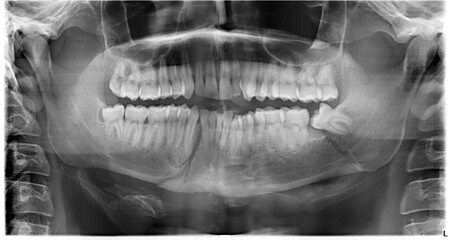 Orthopantomography with fracture of the lower jaw due to aggression