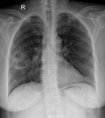 Diagnostic Precision: Interpreting High-Resolution Chest X-ray Findings