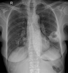 Interpreting Posteroanterior (PA) Chest X-rays in the Erect Position