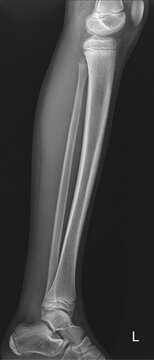 Lower limb tibia fibula lateral radiograph
