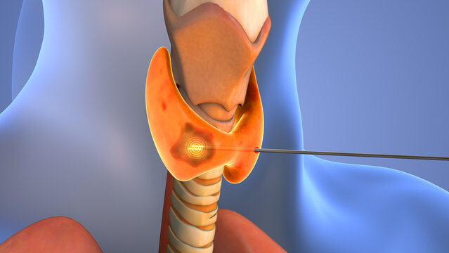 Thyroid nodule treatment medical animation