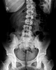 X-ray of idiopathic scoliosis of lumbar spine. Part of adolescent skeleton with spinal curvature on...