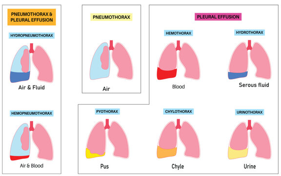 Medical Illustration of Pneumothorax and Pleural Effusion Types with Air, Blood, Serous Fluid, Pus, Chyle, and Urine in Lungs