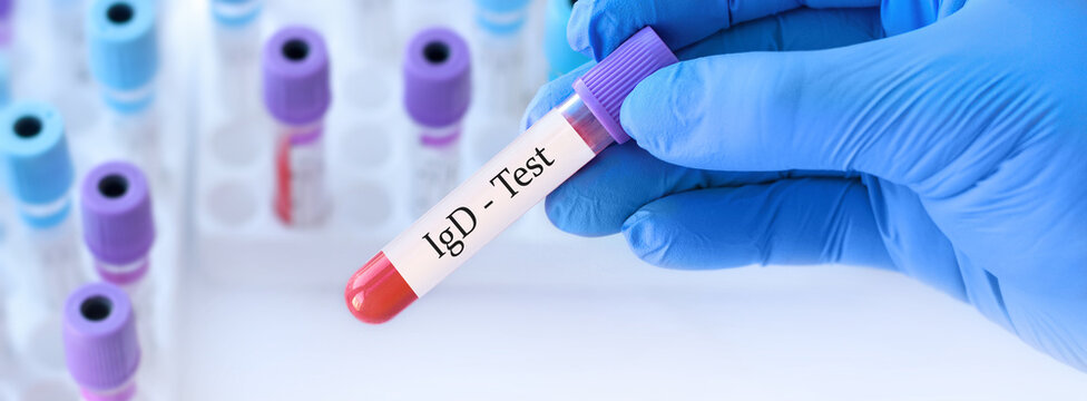 Doctor holding a test blood sample tube with IgD (Immunoglobulin D) test on the background of medical test tubes with analyzes.
