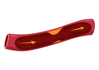 Atherosclerosis stage. Anatomy of heart attack. Arteriosclerotic vascular disease or ASVD. Atherosclerotic plaque in coronary artery. illustration on white background