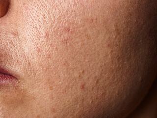 Close-up of acne skin showing problems: inflammation and rashes reflecting the condition of the face