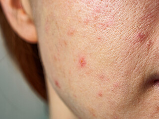 Close-up of acne skin showing problems: inflammation and rashes reflecting the condition of the face