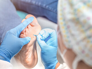 Close-up of a podiatry treatment. Selective focusFemale podiatrist doing chiropody in her podiatry...