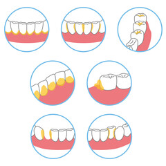 歯に溜まった歯垢　歯磨き　磨き残し