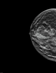 Mammogram. Left bilateral craniocaudal (CC) view (with tomosynthesis and C-view reconstruction), fibroglandular and lipomatous structure (ACR C), benign bilateral calcifications, breast cysts present