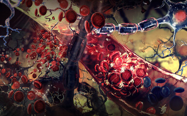 Ischemic brain stroke concept, illustration showing human brain and close-up view of blood vessel 