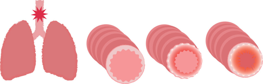 気管支と肺　喘息疾患のイメージのイラスト