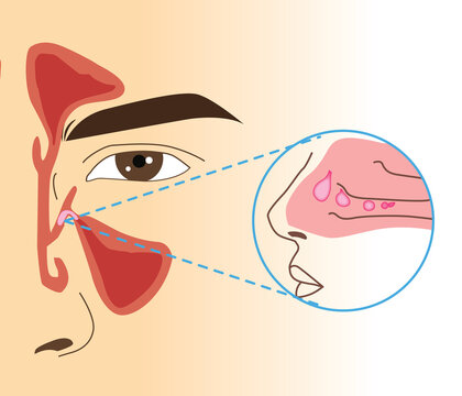 ์Nasal polyp section in human, illustration close up and zoom