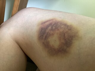 Bruise