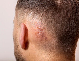Obraz premium Actinic Keratoses on Person's Head: Close-Up Image
