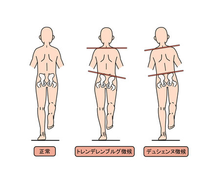 トレンデレンブルグ徴候とデュシエンヌ徴候（文字あり）