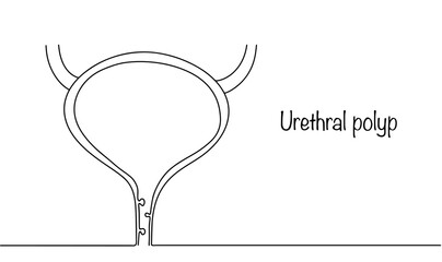 Urethral polyp