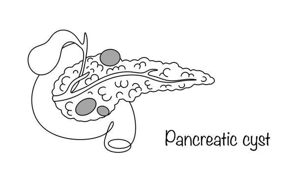 Pancreatic cyst